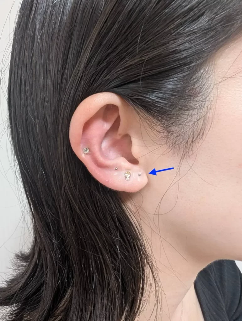 チタンの耳ツボシール